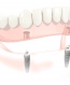 dentadura sobre  2 implantes