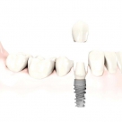 implant + funda