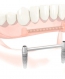Pròtesi amb 2 implants