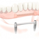 Pròtesi amb 2 implants